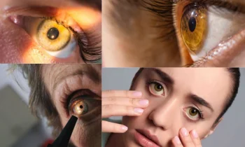 Sarı Nokta Hastalığı Tedavisi Nasıl Sonuçlanır?