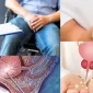 Prostatik Arter Embolizasyonu Hangi Rahatsızlık için Yapılır?
